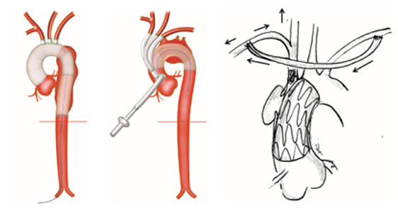 Can thiệp động mạch chủ ngực