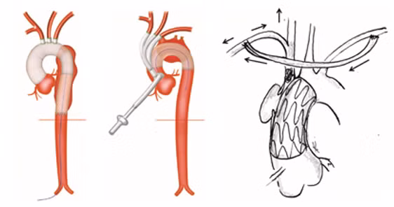 Can thiệp động mạch chủ ngực