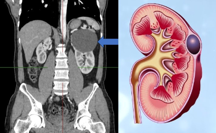 Hình ảnh nang đơn thận - Ảnh BSCC