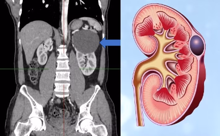 Hình ảnh nang đơn thận - Ảnh BSCC