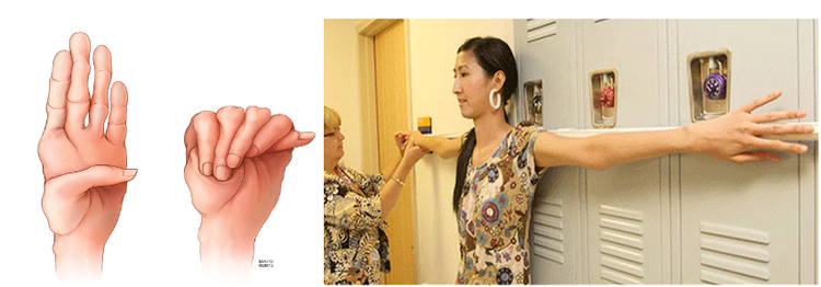 Hình ảnh ngón tay, ngón chân dài bất thường ở bệnh nhân có hội chứng Marfan - Ảnh BSCC