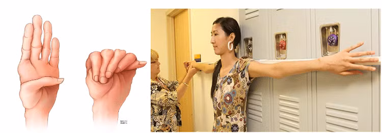 Hình ảnh ngón tay, ngón chân dài bất thường ở bệnh nhân có hội chứng Marfan - Ảnh BSCC