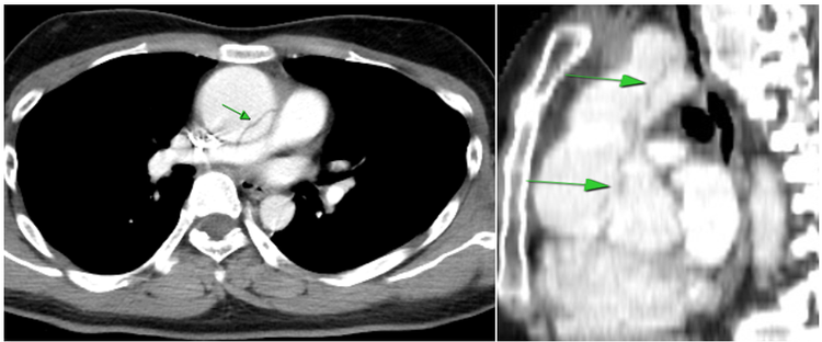 Hình ảnh động mạch chủ ngực giãn và lóc tách (mũi tên xanh) - Ảnh BSCC