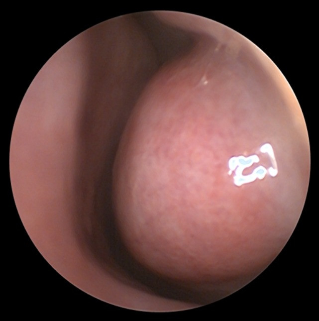 Quá phát cuống mũi