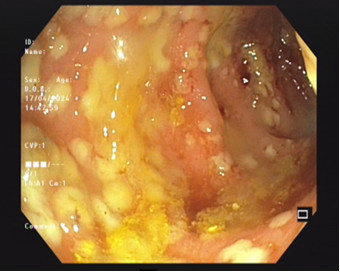 Hình ảnh viêm đại tràng giả mạc qua nội soi của bệnh nhân - Ảnh BVCC