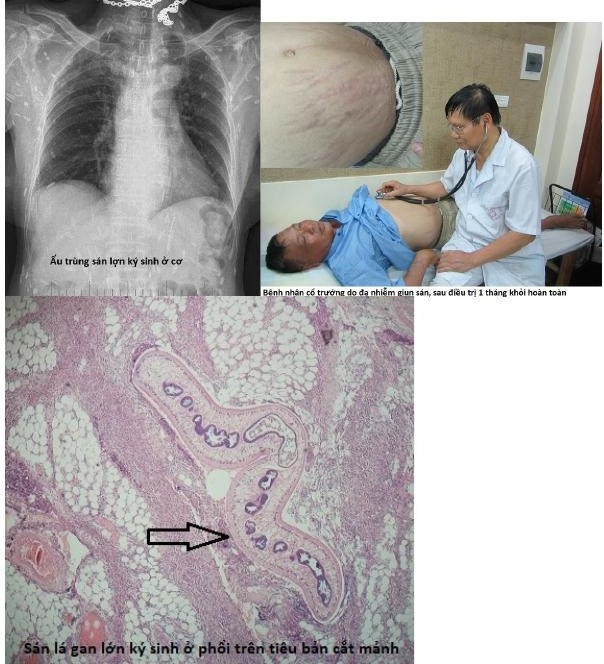 Một số biểu hiện của ký sinh trùng