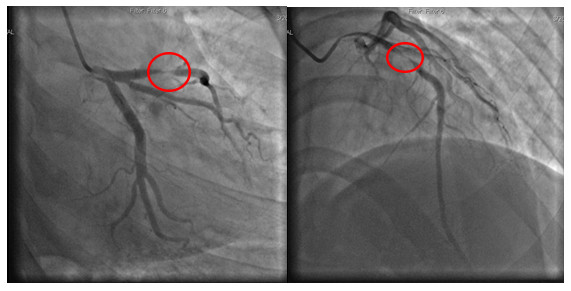Hình ảnh phim chụp thể hiện động mạch bị tắc - Ảnh BVCC