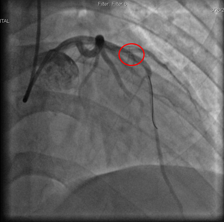 Hình ảnh phim chụp sau can thiệp động mạch được tái thông - Ảnh BVCC