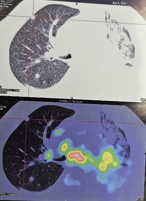Hình ảnh PET/CT tổn thương trên ngực - Ảnh BVCC