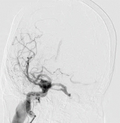 Ù tai, đỏ mắt không ngờ rò động mạch cảnh xoang hang sau tai nạn ảnh 2