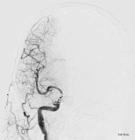 Ù tai, đỏ mắt không ngờ rò động mạch cảnh xoang hang sau tai nạn ảnh 1