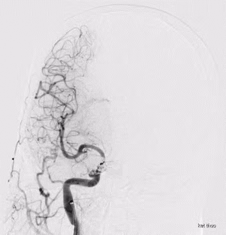 Ù tai, đỏ mắt không ngờ rò động mạch cảnh xoang hang sau tai nạn ảnh 1 Ù tai, đỏ mắt không ngờ rò động mạch cảnh xoang hang sau tai nạn ảnh 1
