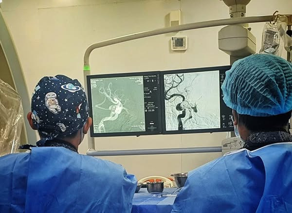 Ca can thiệp rò động mạch cảnh xoang hang cho bệnh nhân - Ảnh BVCC