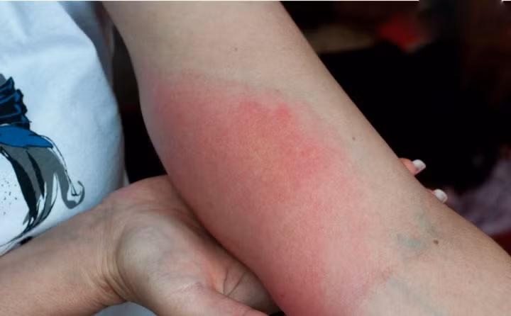 Người đàn ông sốc phản vệ do ong khoái đốt - Ảnh BVCC