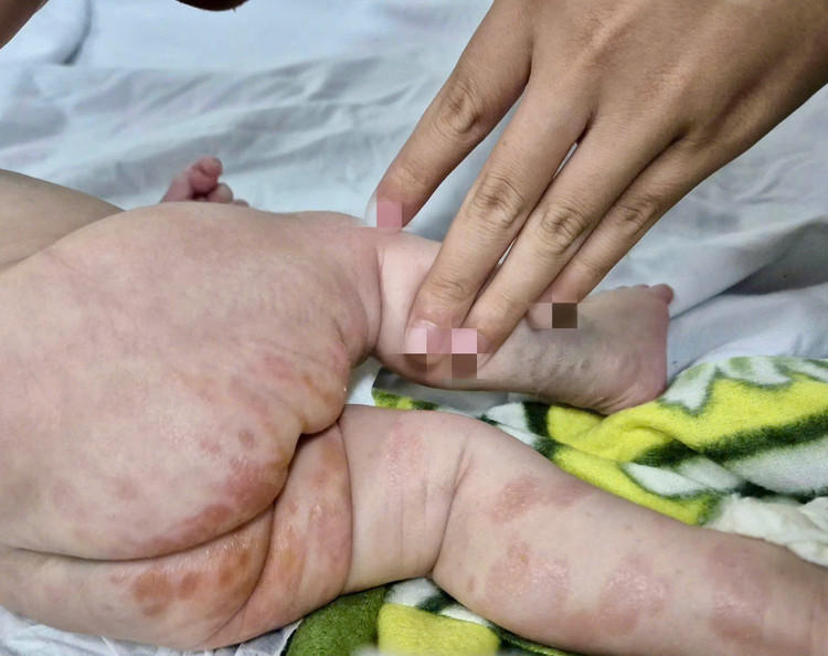 Bé trai 2 tháng tuổi loét khắp người vì mắc giang mai bẩm sinh ảnh 1