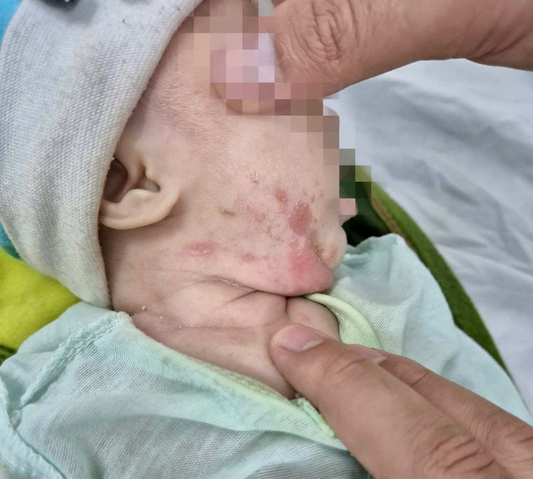 Trẻ bị giang mai bẩm sinh - Ảnh BVCC