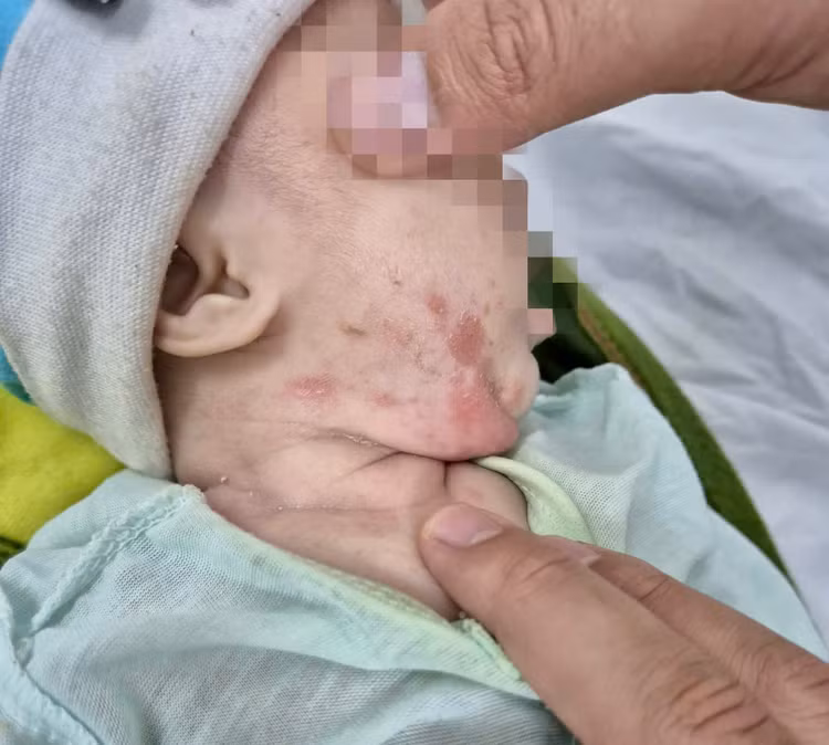 Trẻ bị giang mai bẩm sinh - Ảnh BVCC