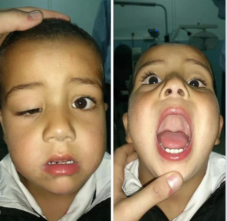 Hội chứng Marcus Gunn.