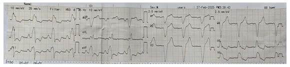 Điện tâm đồ của người bệnh trước khi được can thiệp, QRS 189 ms - Ảnh BVCC