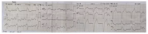 Điện tâm đồ của người bệnh trước khi được can thiệp, QRS 189 ms - Ảnh BVCC