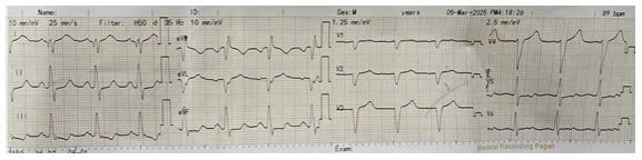 Điện tâm đồ của người bệnh sau khi được can thiệp, QRS 120 ms - Ảnh BVCC
