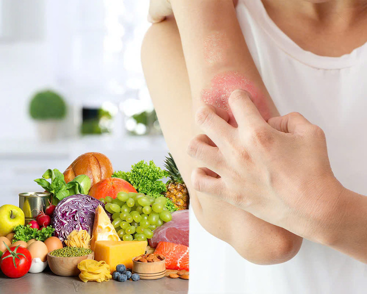 Những lưu ý dinh dưỡng giúp bệnh nhân vảy nến kiểm soát bệnh - Ảnh BVCC