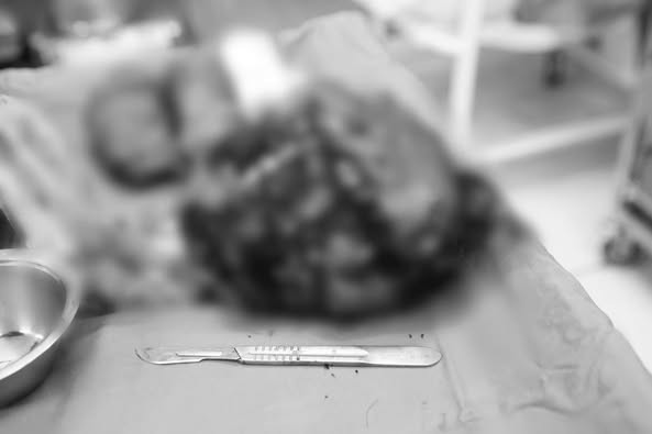 Khối u xơ tử cung lớn được lấy bỏ thành công - Ảnh BVCC