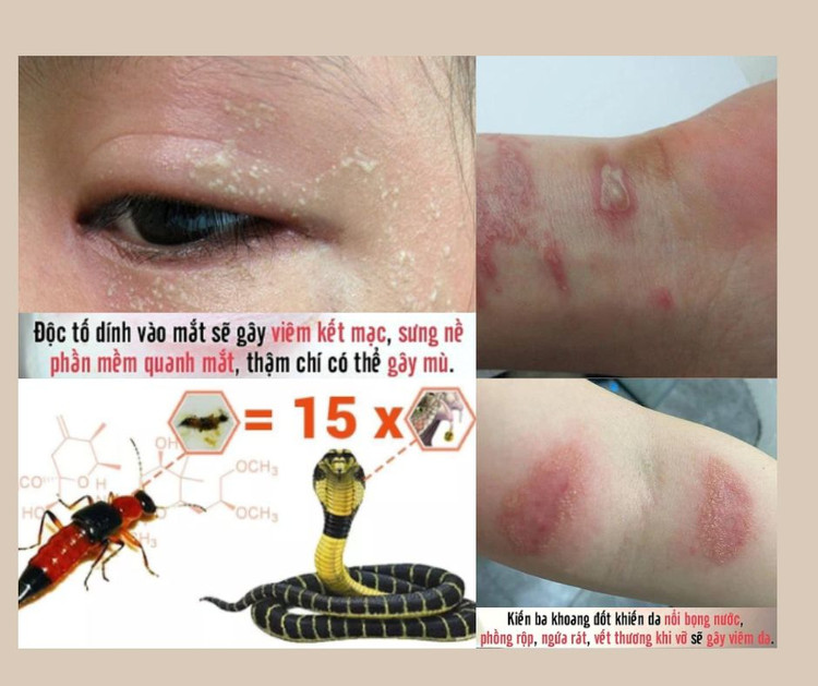 Vết thương do kiến ba khoang đốt - Nỗi ám ảnh dai dẳng