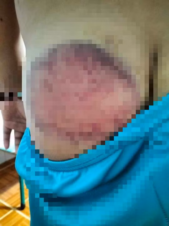 Hình ảnh mông của em H.T bị bầm tím do thầy giáo đánh.