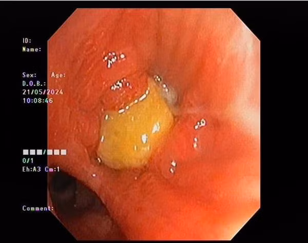 Hạt lạc trong phế quản bệnh nhân - Ảnh BVCC
