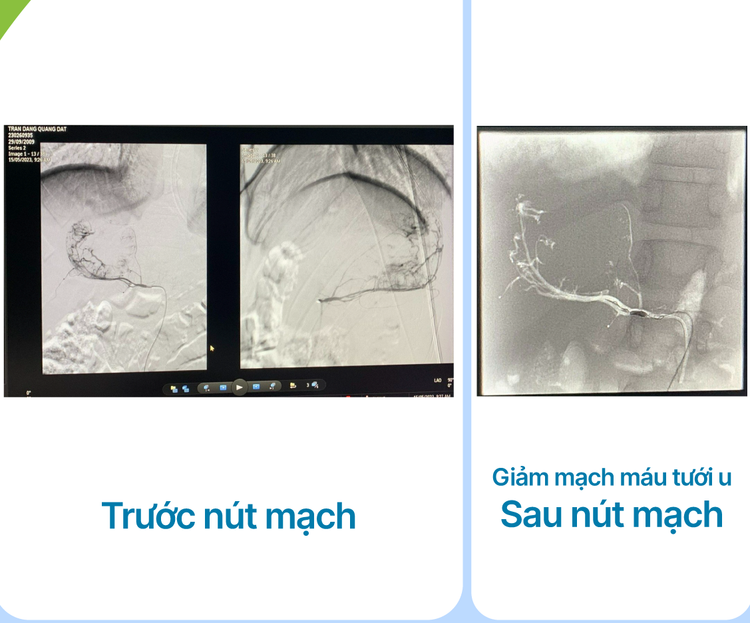 Nút mạch trước phẫu thuật