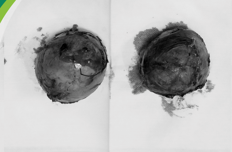 2 khối u tuyến thượng thận được lấy ra