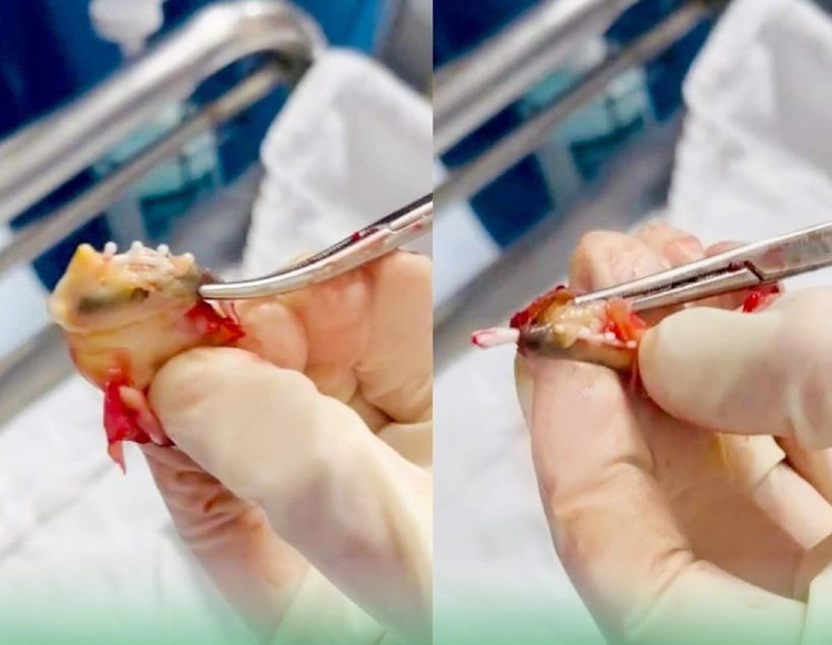 Bất ngờ vòng tránh thai bọc trong khối u xơ tử cung - Ảnh: BVCC