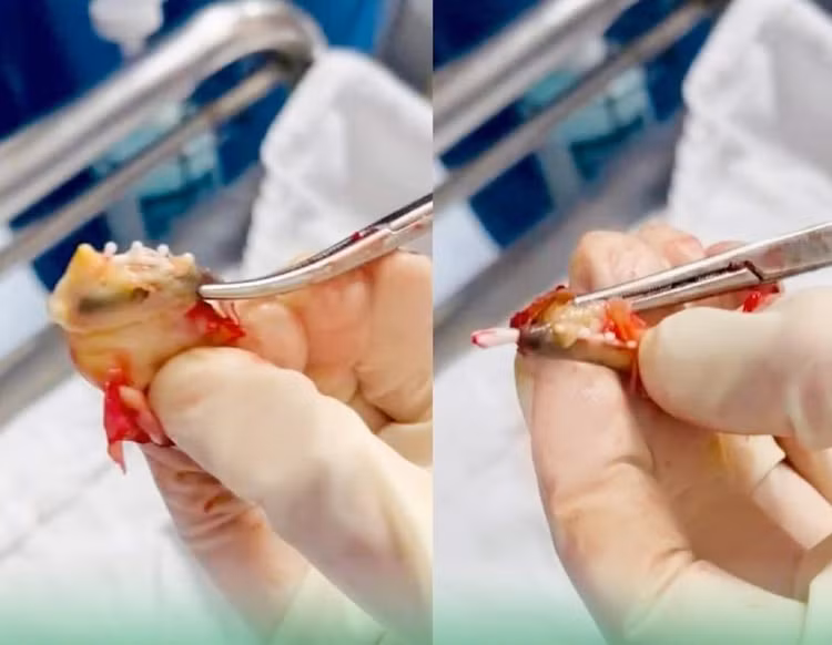 Bất ngờ vòng tránh thai bọc trong khối u xơ tử cung - Ảnh: BVCC