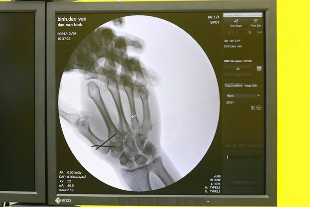 Kết quả chụp X-quang cho thấy bệnh nhân bị gãy đốt 1 của ngón cái, mất vận động bàn tay - Ảnh BVCC,