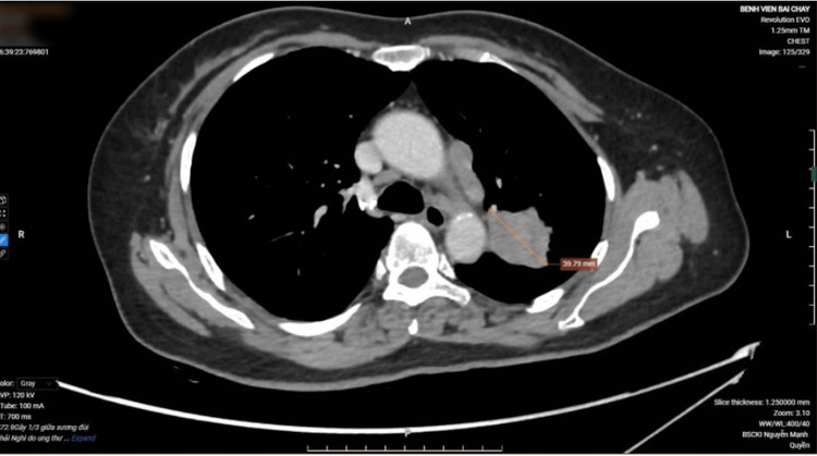 Hình ảnh khối u phổi của bệnh nhân - Ảnh BVCC