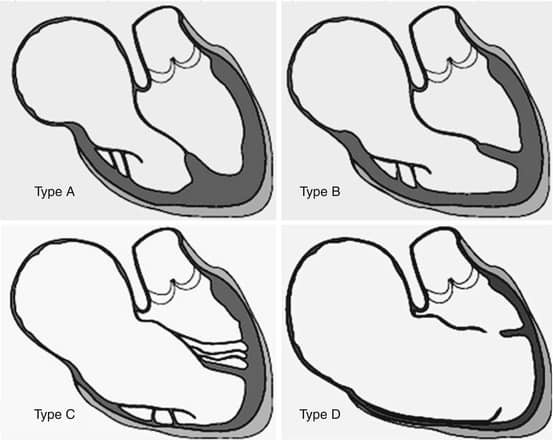 Bất thường Ebstein