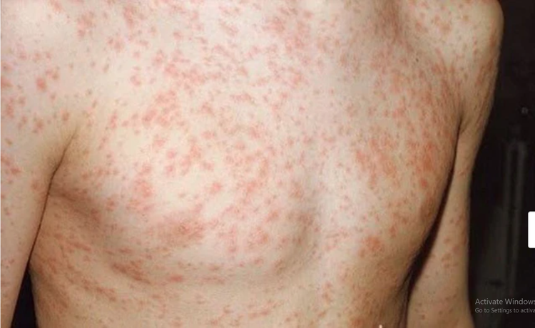 Các chuyên gia cảnh báo, 2024 là năm dịch sởi có nguy cơ bùng phát - Ảnh minh hoạ.