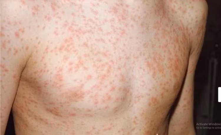 Các chuyên gia cảnh báo, 2024 là năm dịch sởi có nguy cơ bùng phát - Ảnh minh hoạ.