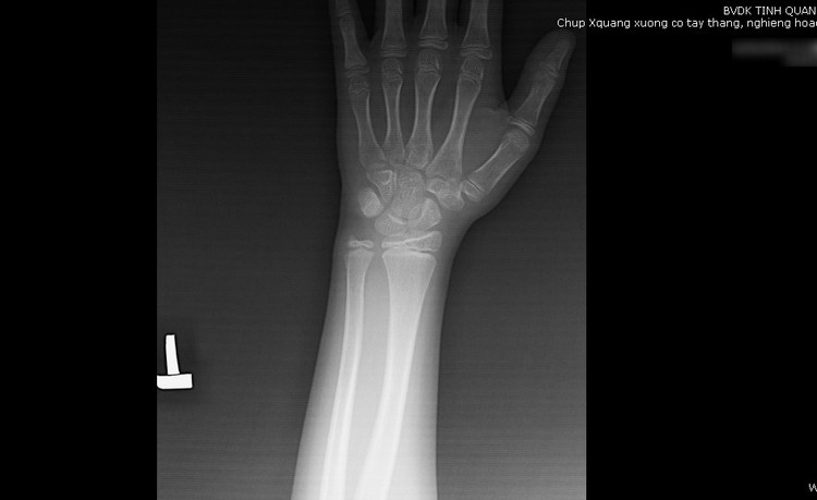 X-quang xương cổ tay trái của trẻ 7 tuổi dậy thì sớm - Ảnh BVCC