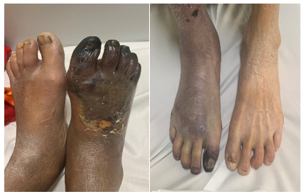 Hoại tử chi do bệnh động mạch ngoại biên giai đoạn muộn - Ảnh: Bệnh viện Hữu nghị Việt Đức Hoại tử chi do bệnh động mạch ngoại biên giai đoạn muộn - Ảnh: Bệnh viện Hữu nghị Việt Đức