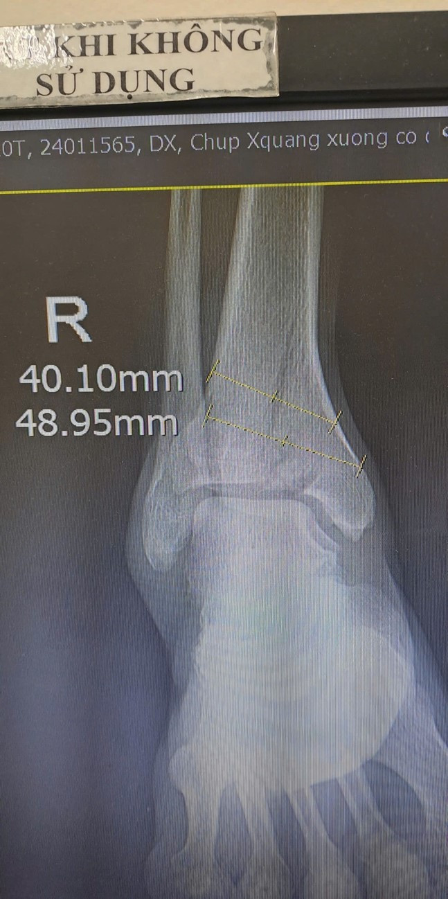 Hình ảnh xương gãy trên phim chụp - Ảnh BVCC Hình ảnh xương gãy trên phim chụp - Ảnh BVCC