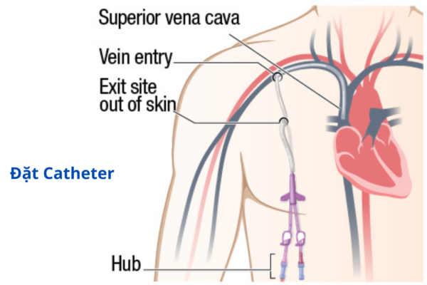 Đặt Catheter đường hầm Cuff – Giải pháp mới trong lọc máu cho người bệnh