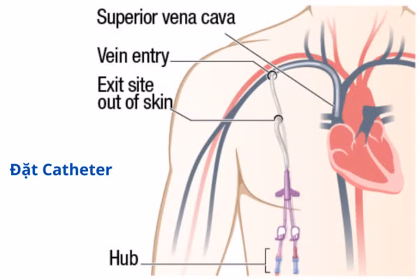 Đặt Catheter đường hầm Cuff – Giải pháp mới trong lọc máu cho người bệnh