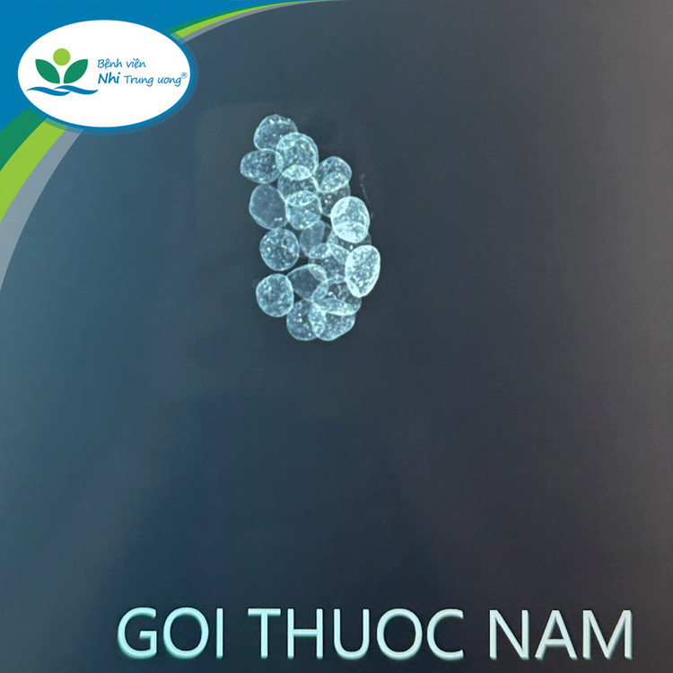 Hình ảnh viên thuốc nam trẻ uống không rõ nguồn gốc có chứa chì trên phim chụp Xquang