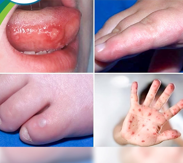 Bệnh tay chân miệng tái nhiễm nhiều lần... biến chứng nguy hiểm ảnh 1