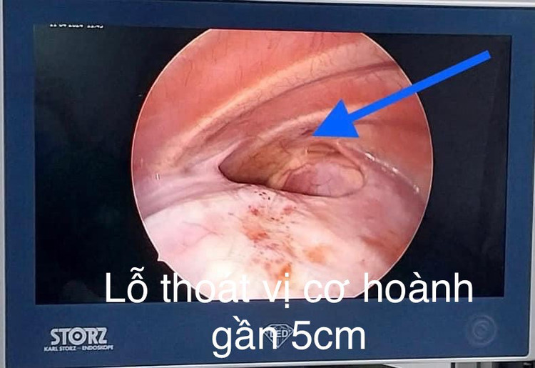 Lỗ thoát vị hoành P gần 5 cm