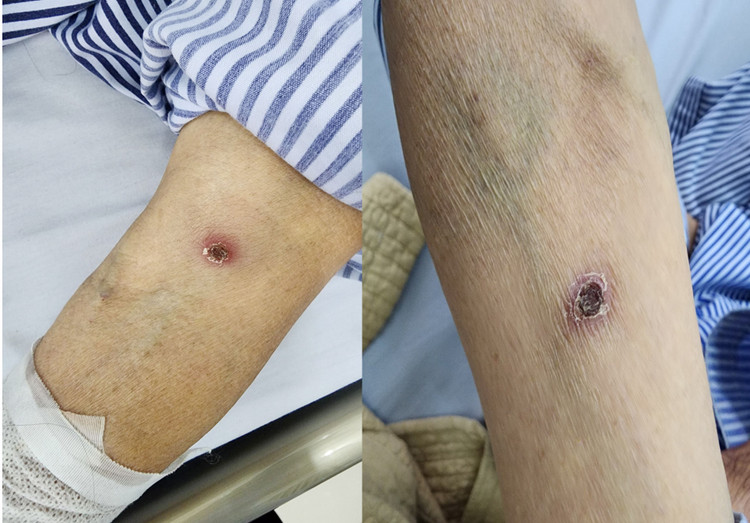 Vết loét điển hình của sốt mò - Ảnh BVCC