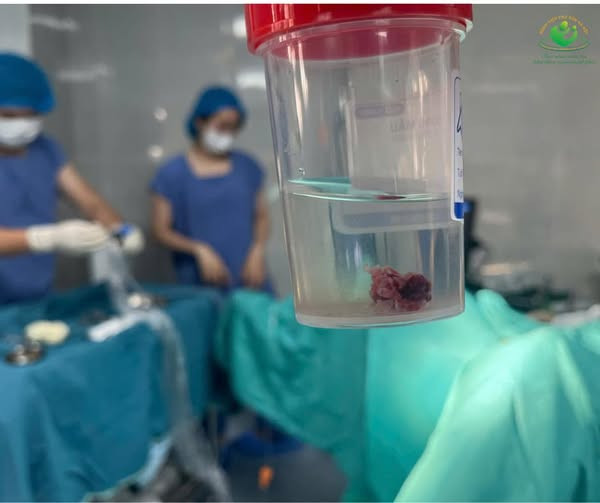 Các bác sĩ đã phẫu thuật cắt đa polyp cho trẻ - Ảnh BVCC