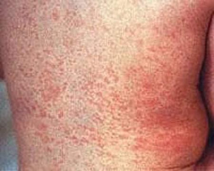 Ban xuất hiện khoảng 5-6 ngày và khi “tàn” sẽ có màu hơi nâu nâu rồi sẽ biến mất, để lại lớp da khô, bong tróc.